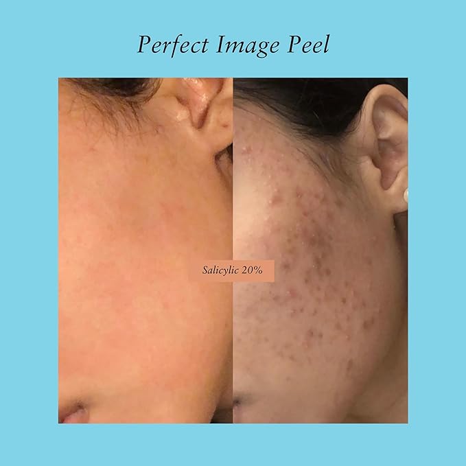 Salicylic Gel Chemical Peel - Enhanced with Green Tea Extract and Tea Tree Oil (20% Strength)