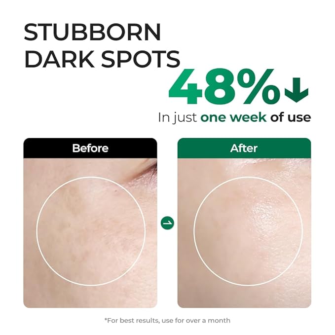 EASYDEW Dark Spot Correcting Serum for Uneven Skin Tone & Dull Skin – EGF, Niacinamide & Glutathione, Anti-Aging Formula, 30ml