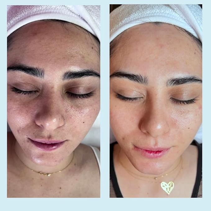 Salicylic Gel Chemical Peel - Enhanced with Green Tea Extract and Tea Tree Oil (20% Strength)