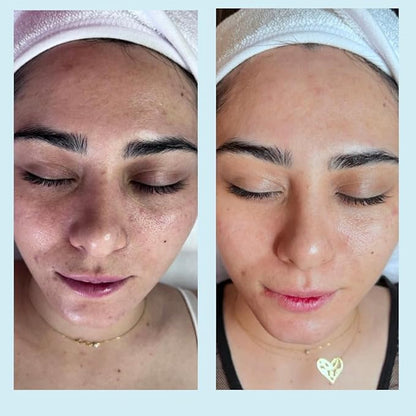Salicylic Gel Chemical Peel - Enhanced with Green Tea Extract and Tea Tree Oil (20% Strength)