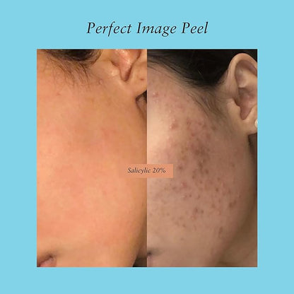 Salicylic Gel Chemical Peel - Enhanced with Green Tea Extract and Tea Tree Oil (20% Strength)