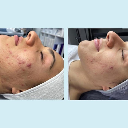 Salicylic Gel Chemical Peel - Enhanced with Green Tea Extract and Tea Tree Oil (20% Strength)