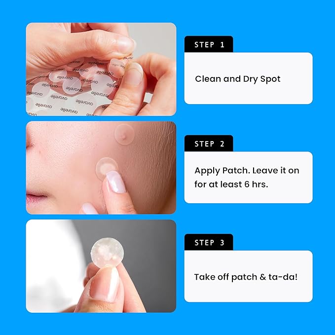 AVARELLE Pimple Patches for Face | Hydrocolloid Acne Patches for Covering Blemishes | FSA HSA Store Eligible Zit Patches with Tea Tree, Calendula, & Cica | (10-14 mm, 300 Count) Bulk Pack