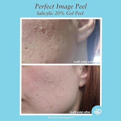Salicylic Gel Chemical Peel - Enhanced with Green Tea Extract and Tea Tree Oil (20% Strength)