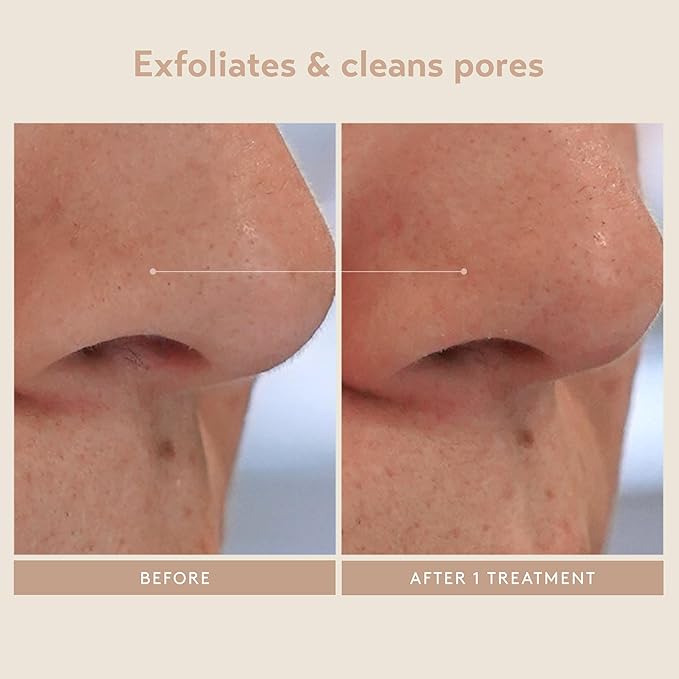 SHANI DARDEN SKIN CARE Triple Acid Peel, 2-Step Exfoliating Face Peel with Mandelic, Lactic & Glycolic Acids, Kaolin Clay Neutralizing Mask & Brush, Helps Improve Dark Spots & Skin Texture, 0.5 fl oz