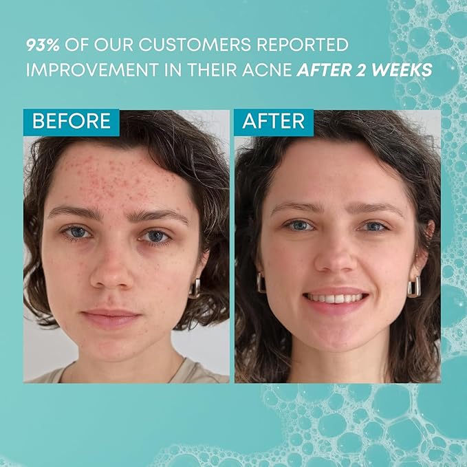 Gle Clean Acne Foaming Wash Face, Skin, Back and Body - 6.7 Fl Oz - Dermatologist-Tested Non-Foaming Cleanser - Vegan, Cruelty-Free