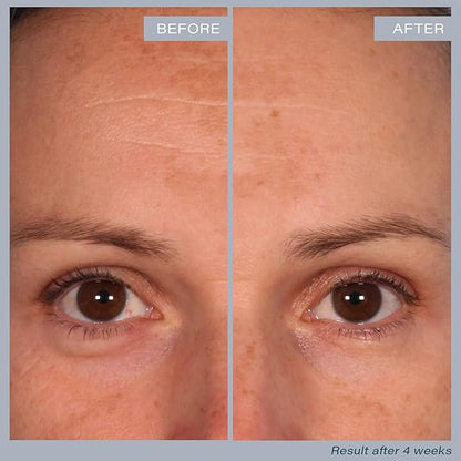 SKINN Multi-Acid Resurfacing Pads, with Glycolic, Lactic & Salicylic Acid, 60 Pads - Witch Hazel Chemical Peel for Face, Neck & Decollete Exfoliates, Brightens & Tones Skin, for Fine Lines & Wrinkles