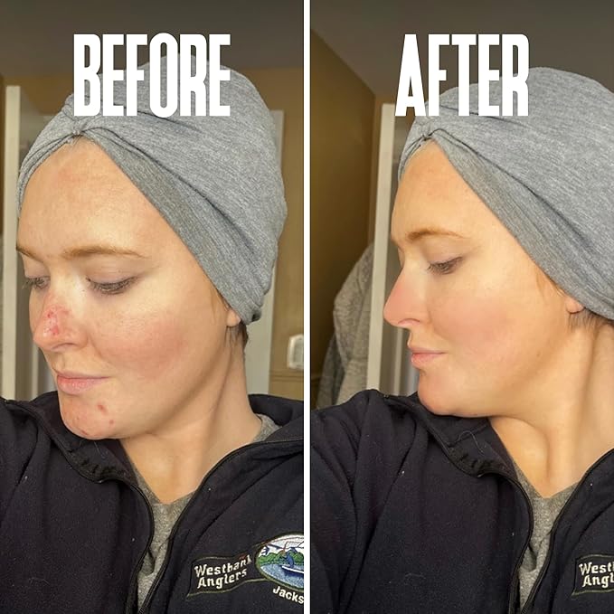 Glycolic Acid Peel 40% Professional Chemical Peel for Face for Acne Scars, Collagen Boost, Wrinkles, Fine Lines - Alpha Hydroxy Acid Liquid Exfoliant for Face Peel Mask for Men & Women