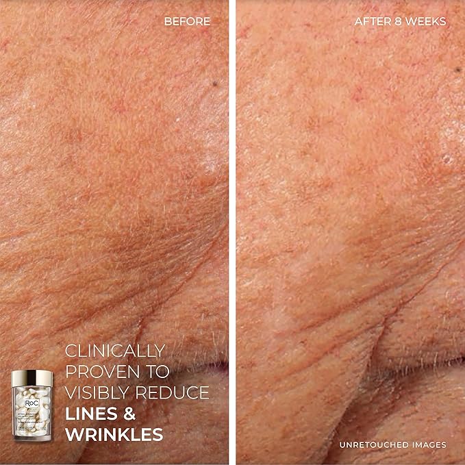 RoC Retinol Correxion Line Smoothing Eye Cream + Retinol Serum Capsules For Night + Max Hydration Crème With Hyaluronic Acid For Day, Skin Care Routine for Women and Men