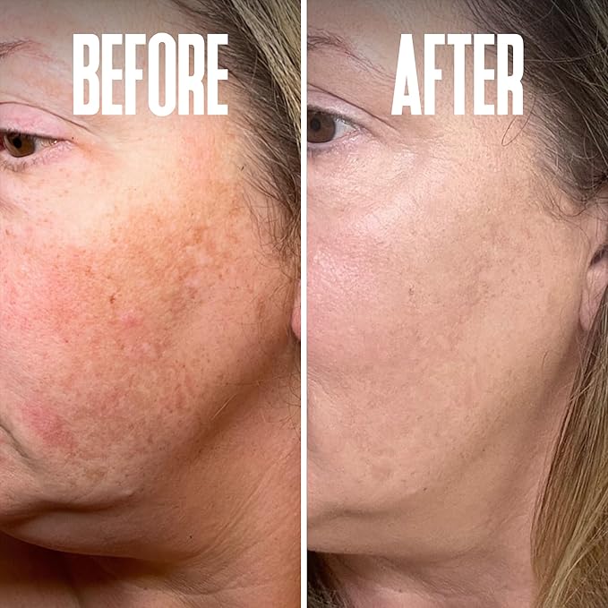 Dark Spot Corrector, Dark Spot Remover for Face - For Stubborn Dark Spots Serum, Dark Spot Remover with Kojic Acid, Alpha Arbutin, Mulberry Extract, Brightening Discoloration Correcting Serum