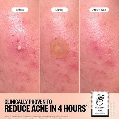 PEACE OUT Acne Healing Dots Helps Clear Blemishes Overnight, Fast Acting Hydrocolloid Pimple Patches for Breakouts with Salicylic Acid, Retinol and Aloe Vera, Award Winning Skincare Solution 40 Count