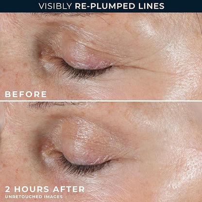 RoC Retinol Correxion Deep Wrinkle Non-Invasive Targeted Patches with Hyaluronic Acid + Firming Peptides for Forehead, 11 Lines, Crow’s Feet and Laugh Lines, (6 Patches) with Retinol Eye Packette