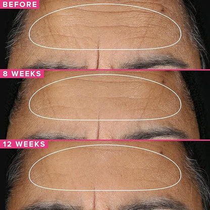 Farmacy Retinol Serum for Face - 1% Vitamin A Anti Aging - Resurfacing Wrinkle Formulated with Encapsulated Retinol + Ceramide NP to Prevent Moisture Loss + Replenish Skin Barrier (30ml)